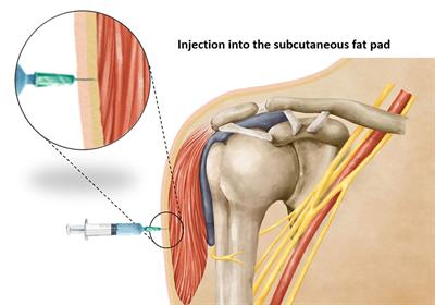 Appropriate intra<mark class="highlighted">deltoid</mark> muscle needle penetration depth in vaccine administration: an MRI study in Thailand